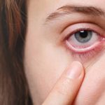 eye irritation caused by conjunctivitis