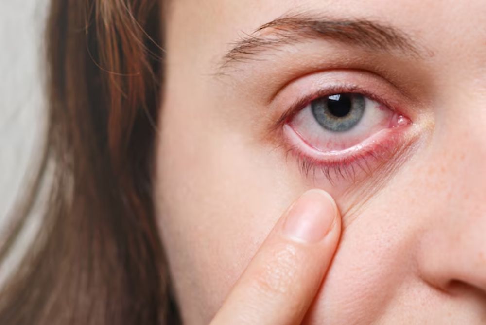 eye irritation caused by conjunctivitis